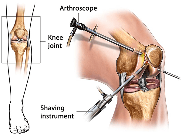 KNEE ARTHROSCOPY