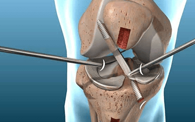 Patient Testimonial | ACL Reconstruction + Meniscal Repair