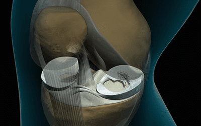 Medial Meniscus Repair | DELHI SPORTS DOC