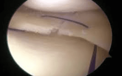 Arthroscopic Notchplasty