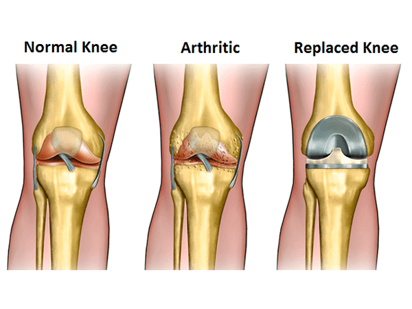 Knee Surgery 